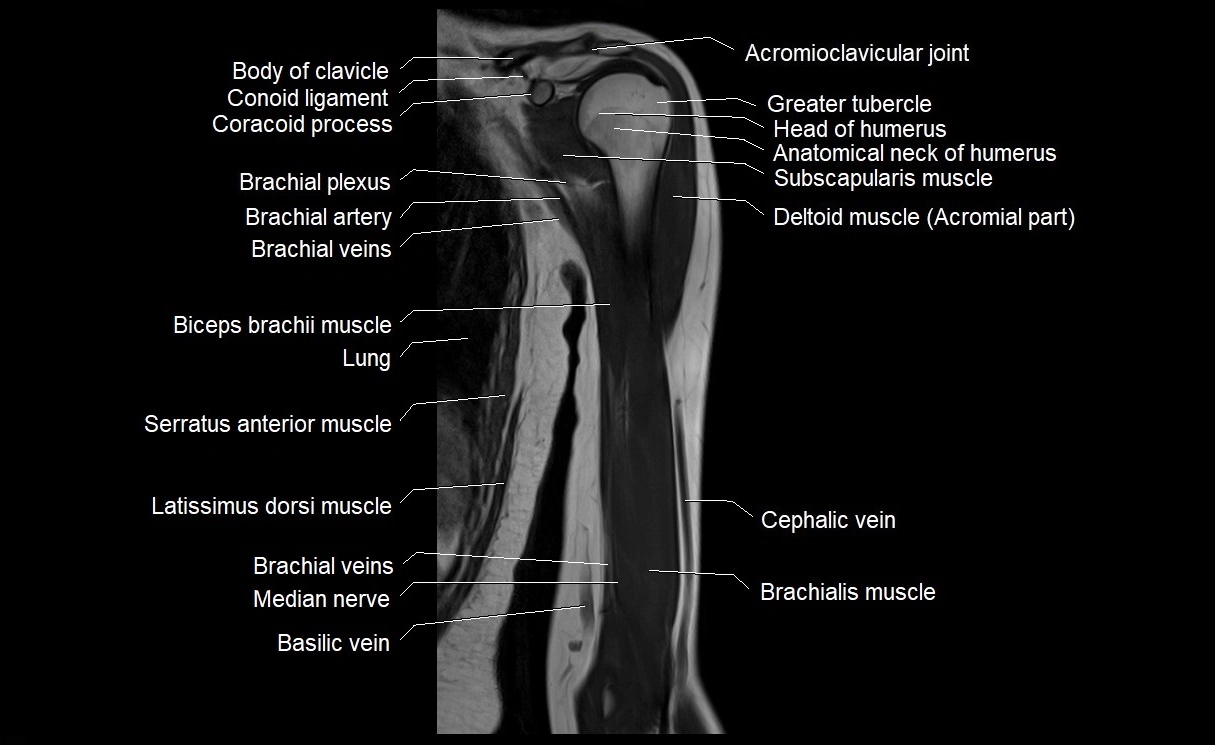 MRI upper arm (humerus ) coronal cross sectional anatomy image 10.webp